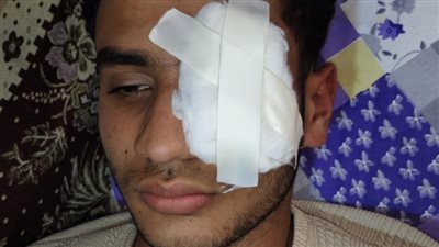 ضربه بالبوكس بسبب الستات.. شاب يفقأ عين آخر إثر مشاجرة في طنطا 