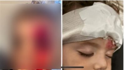 بعد الموافقة على لائحة القانون الجديد.. سيدة تستغيث بعد تعرض صغيرها لتشوه بسبب كلب في القاهرة الجديدة