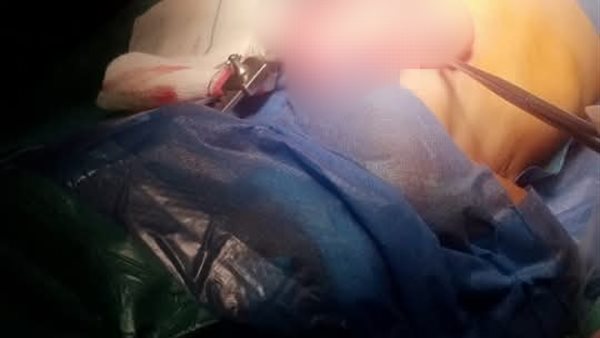 إنقاذ حياة طفل به