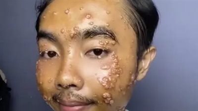 إصابة رجل بمرض جلدي خطير بسبب ارتداء ملابس مستعملة دون غسلها 