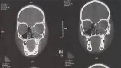 فريق طبي بجامعة أسيوط ينقذ بصر طفل يعاني من خراج خطير بالعين| صور
