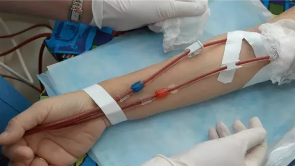 جلسة غسيل كلوي