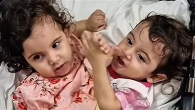 فصل توأم ملتصق من الصدر والبطن في عملية جراحية استمرت 15 ساعة