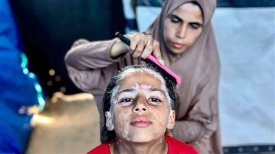 كنت حلوة قبل الحرب.. لانا الشريف طفلة فلسطينية شيبتها إسرائيل وغزاها البهاق من الخوف