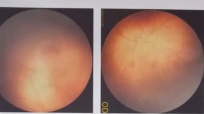 ضمن مبادرة رؤية أمل.. نجاح أول عملية حقن بدواء لوسنتس لطفل مبتسر بمستشفى رمد المنصورة