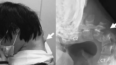 بسبب الإفراط في استخدام الهاتف.. شاب ياباني يصاب بمتلازمة سقوط الرأس 