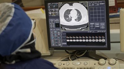 أداة ذكاء اصطناعي تتنبأ بسرطان الرئة لدى غير المدخنين بدقة مذهلة.. تعرف على التفاصيل