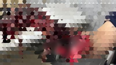 مستشفى دمياط التخصصي ينقذ يد شاب تعرض لإصابة مروعة