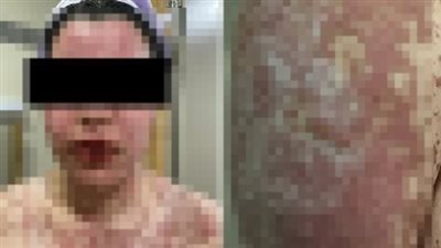 سيدة تفقد ثلث جلدها بعد 4 أيام من تناول دواء لاضطراب المزاج