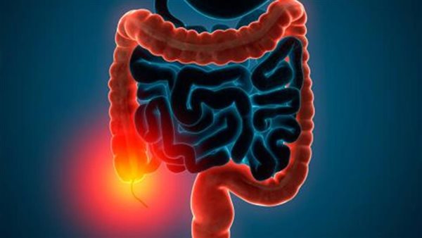 التهاب القولون التقرحي
