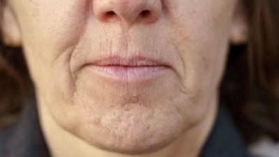 عادات تسبب الإصابة بتجاعيد البشرة حول الفم
