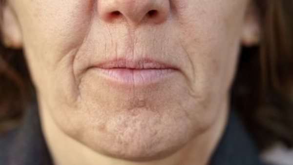 تجاعيد البشرة حول