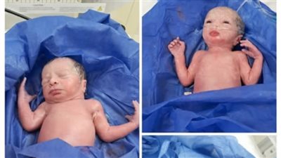 صحة المنيا: ولادة 3 توائم بمستشفى العدوة المركزي.. وحالتهم مستقرة 