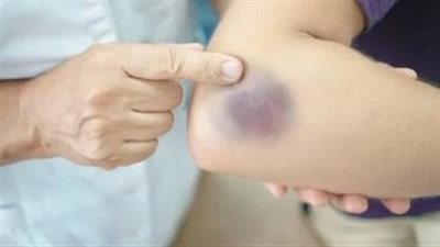 علامة تحذيرية تظهر على الجلد تشير للإصابة بأمراض مميتة.. تعرف عليها