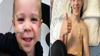  بريطاني يعاني من حالة نادرة تجعله غير قادر على تناول الطعام