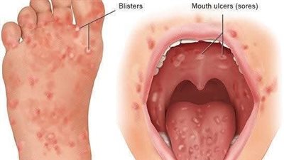 تجنب المُضاد الحيوي نهائيًا.. استشاري طب الأطفال وحديثي الولادة يحذر من انتشار مرض كواساكي في الصيف