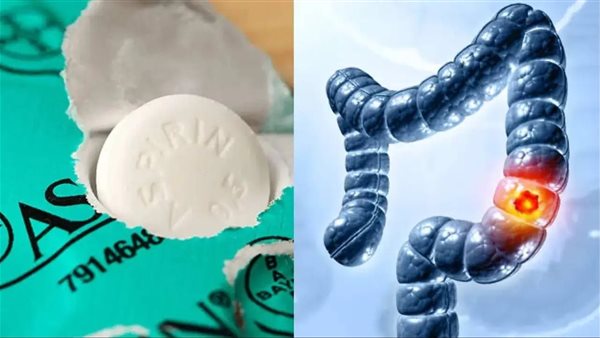 سرطان الأمعاء ـ تعبيرية