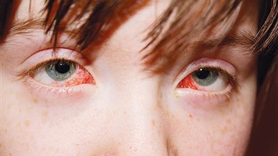 سيدة تستغيث لعلاج نجلها في الخارج: يعاني من ضمور العصب البصري.. والدواء غير متوافر بمصر