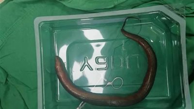 استخراج ثعبان بحر حي من بطن رجل صيني بعد جراحة طارئة