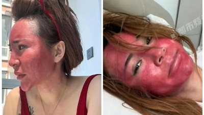 صينية تصاب بتشوه جلدي حاد بعد تجاهل إزالة المكياج لمدة 22 عامًا
