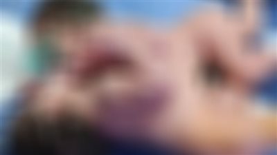 ولادة نادرة لـ توأم ملتصق بمستشفى الفيوم العام