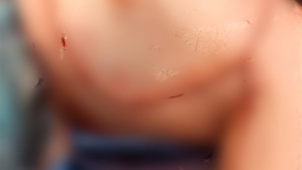 جانب من العملية الجراحية