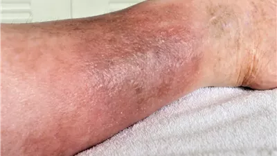 ما هو القصور الوريدي المزمن الذي يعاني منه ترامب؟| الأعراض وطرق العلاج