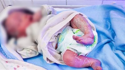 إنجاز طبي جديد بالفيوم.. ولادة نادرة لطفل 