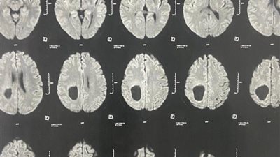 إنجاز طبي بسوهاج الجامعي.. نجاح جراحة ميكروسكوبية دقيقة لاستئصال ورم بالمخ وإنقاذ مريض من مضاعفات خطيرة