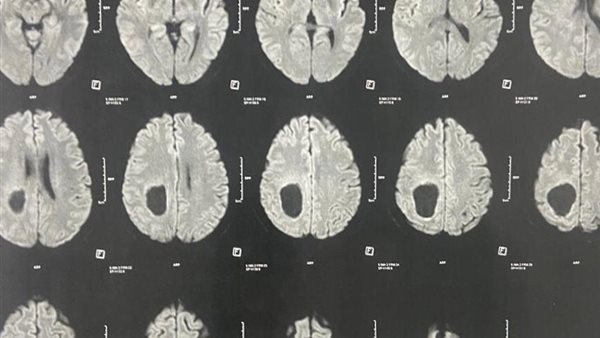 جراحة دقيقة بالمخ