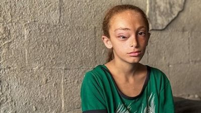 لم تستطع إكمال المقابلة الصحفية.. الصغيرة سارة من غزة تستغيث بسبب ورم سرطاني في الرأس