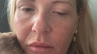 تفشي حالات تسمم خطير في بريطانيا بسبب حقن تجميلية غير مرخصة