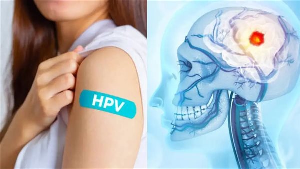 سرطان الرأس ـ تعبيرية