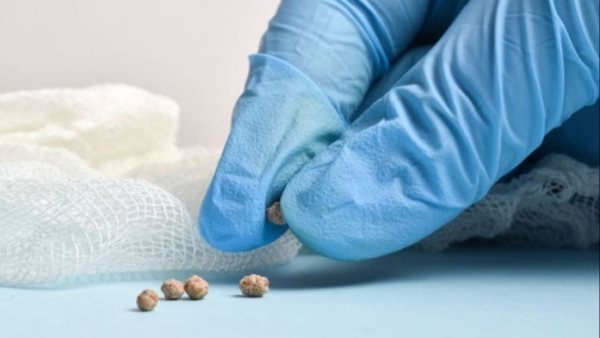 وصفات علاج حصوات