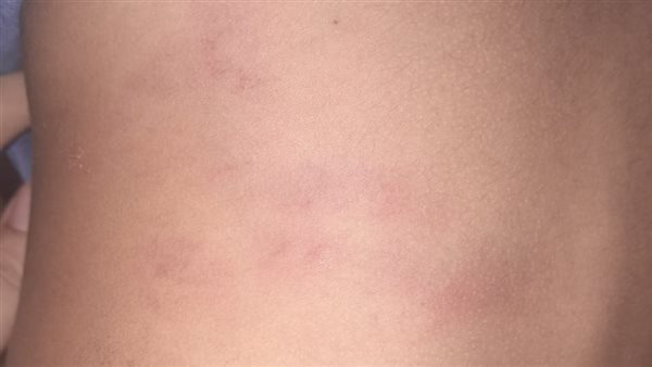 آثار الضرب على الصغير