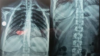 بلعت دبوس الطرحة.. إنقاذ فتاة من اختناق حاد في مستشفيات جامعة المنوفية