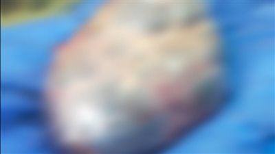 وكيل الصحة بالفيوم يعلن نجاح مستشفى إبشواي في استئصال ورم من بطن مريضة يزن 7 كيلو