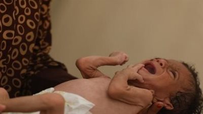  بينهم 96 طفلا.. صحة غزة: ارتفاع شهداء الجوع وسوء التغذية إلى 193