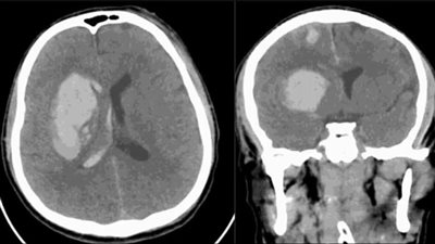 تهدد البشرية.. تحذير طبي من فطر قاتل بعد إصابة نادرة في الإمارات
