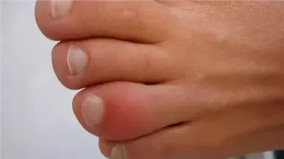 احذر من إصبع السجق.. إصابة شائعة في الصيف قد تتحول لمشكلة مزمنة
