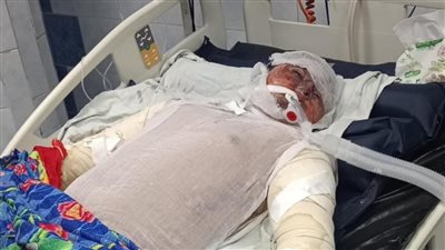 كل دقيقة تأخير تهدد حياته… استغاثة أسرة أحمد ضحية حريق الباكيات بشبرا الخيمة: عايزين مستشفى حروق لإنقاذه 