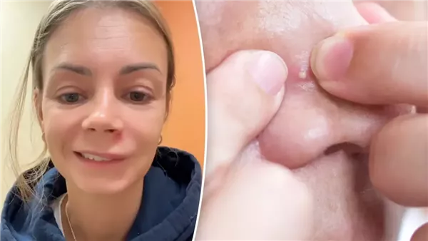 بثرة كادت تقتل شابة