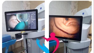 مستشفى رأس التين بالإسكندرية ينجح في تركيب أنابيب تهوية لعلاج التهاب الأذن الوسطى