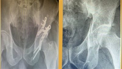 إنجازان طبيان في مجمع الأقصر الطبي.. تشخيص دقيق وجراحات عظام متقدمة تعيد الحركة للمرضى