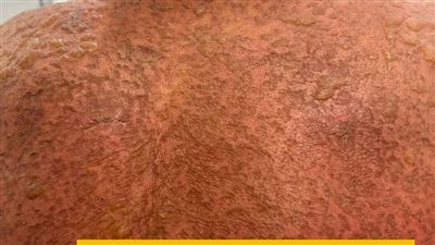 مستشفى المنصورة الدولي ينجح في إنقاذ مريض يعاني مرضًا جلديًا نادرًا 