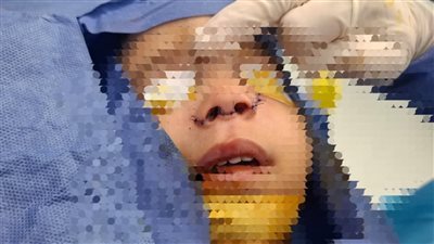 إنقاذ صغيرة من التشوّه بعملية دقيقة في مستشفى قها التخصصي بالقليوبية