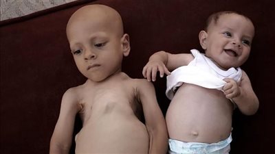 أبو عبد الله صاحب عبارة أنا جعان يستغيث بعد وفاة ابنه: أنقذوا حبيبة من مصير شقيقها | خاص 