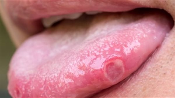 سرطان السان ـ أرشيفية