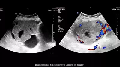 سرطان نادر يتسبب في نتيجة إيجابية لاختبار الحمل