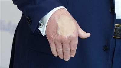 بسبب كثرة مصافحة الرؤساء.. كواليس ظهور مكياج كثيف على يد ترامب